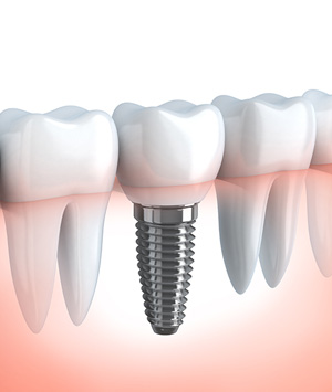 Implant dentaire Albi