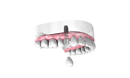 Implantologie dentaire Albi
